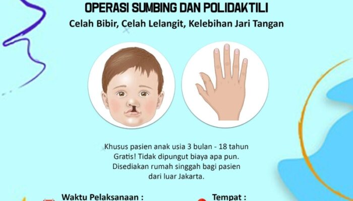 Bakti Sosial Operasi Sumbing dan Polidaktili Digelar Gratis di Jakarta